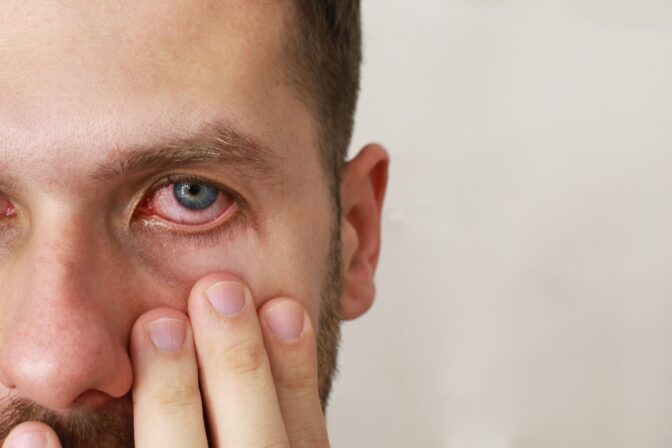 Sattuuko silmiin talviloman jälkeen? Syy voi löytyä yllättävän läheltä