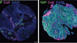 Tutkijat soittivat soluille musiikkia – aggressiiviset kurkunpääsyöpäsolut reagoivat heti