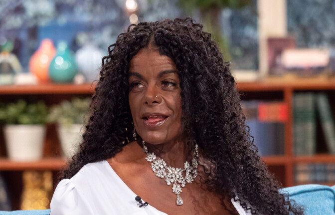 Valkoihoisena syntynyt kohumalli Martina Big on nykyään täysin eri näköinen – uskomaton kuvapari esittelee muutosta